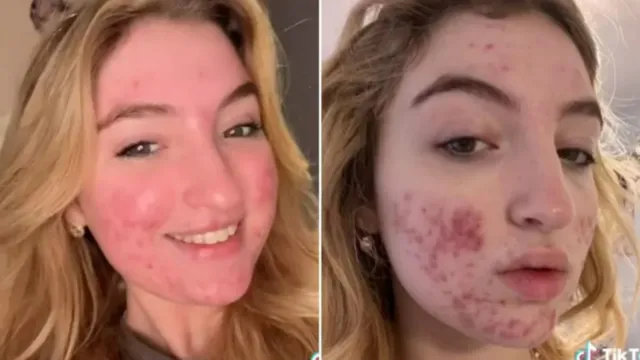 Imagem ilustrativa da notícia TikTok cancela conta de jovem por mancha de acne