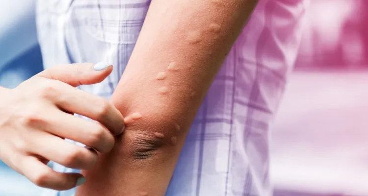 Imagem ilustrativa da notícia Você não precisa pegar esta alergia. Veja como se prevenir!