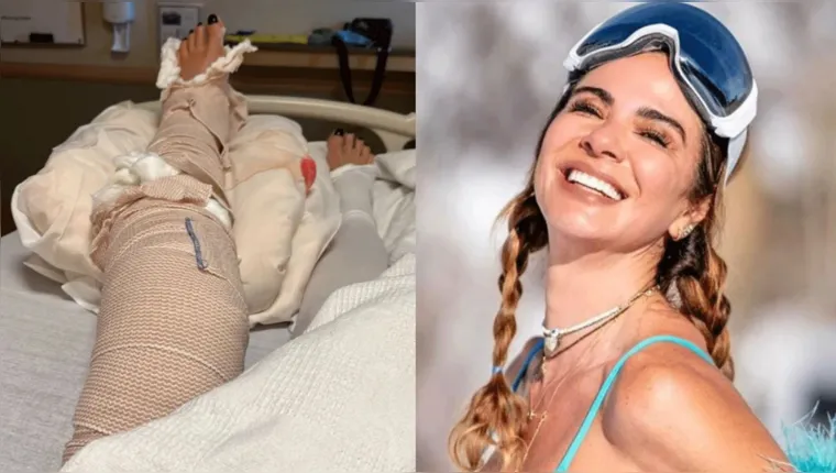 Imagem ilustrativa da notícia Luciana Gimenez mostra cicatrizes após acidente na neve