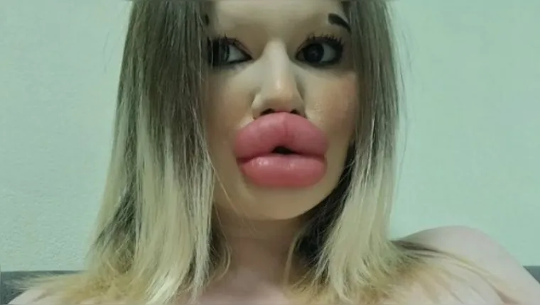 Imagem ilustrativa da notícia Dona dos maiores lábios do mundo anuncia nova plástica
