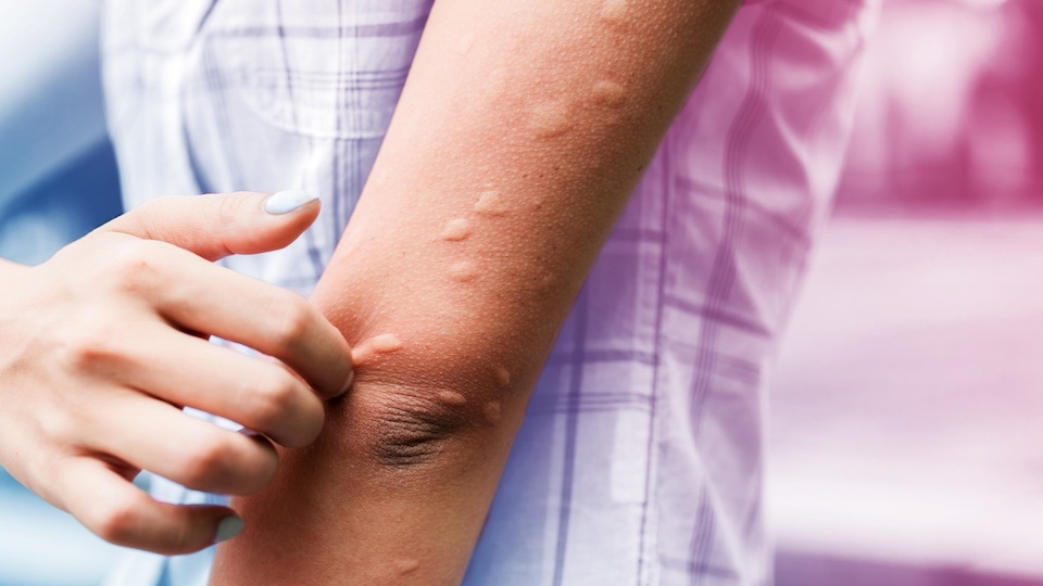 A doença pode provocar coceira e manchas vermelhas na pele, como bolinhas.