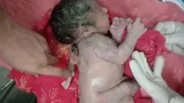 A criança nasceu com dois braços e duas pernas, mas uma terceira mão, que aparece saindo das costas.