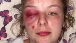 Eleanor Williams, de 22 anos, com o rosto desfigurado após se bater com martelo