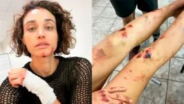 Débora Nascimento exibe os ferimentos em bastidores de Olhar Discreto