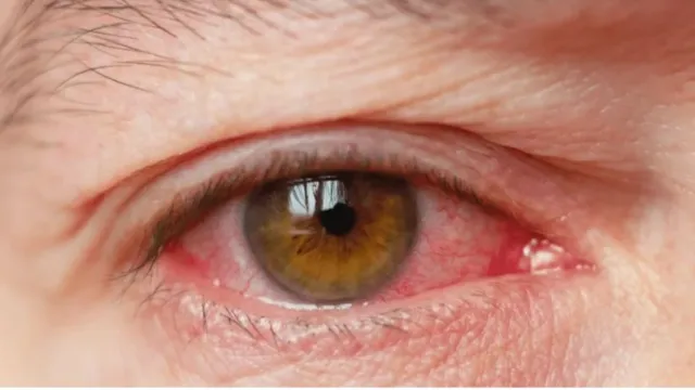 Imagem ilustrativa da notícia Ejaculação nos olhos pode transmitir ISTs? Médica responde