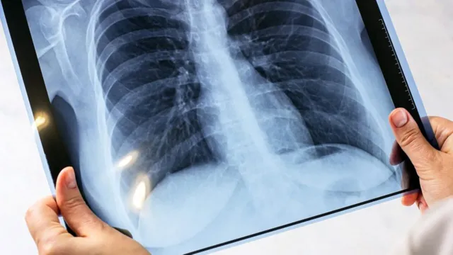 Imagem ilustrativa da notícia Após 20 anos, morte por tuberculose sobe no Brasil