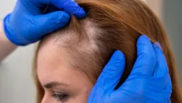 Alopecia androgenética ou calvície