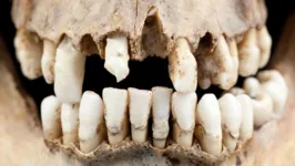 As bactérias dos dentes de neandertais, poderão identificar novos compostos com propriedades antibióticas potentes