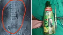 Após engolir a garrafa de óleo para cabelo, o homem teve que passar por cirurgia de emergência.