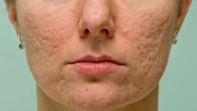 Imagem ilustrativa da notícia Tratamento para acne severa viraliza; conheça opções