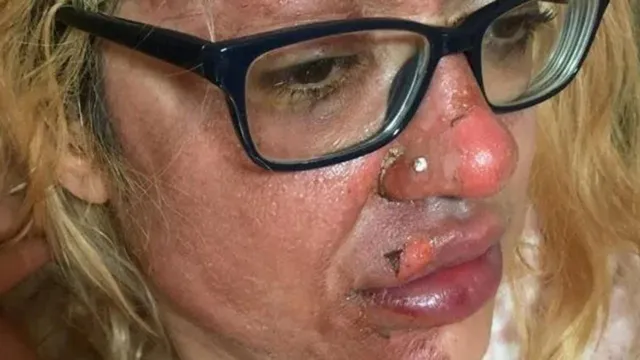 Imagem ilustrativa da notícia Mulher tem rosto queimado após ovo explodir em micro-ondas 
