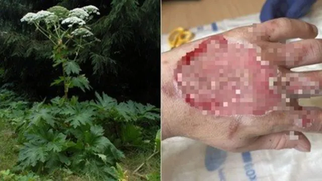 Imagem ilustrativa da notícia Planta venenosa deixa jovem com bolha gigante na mão