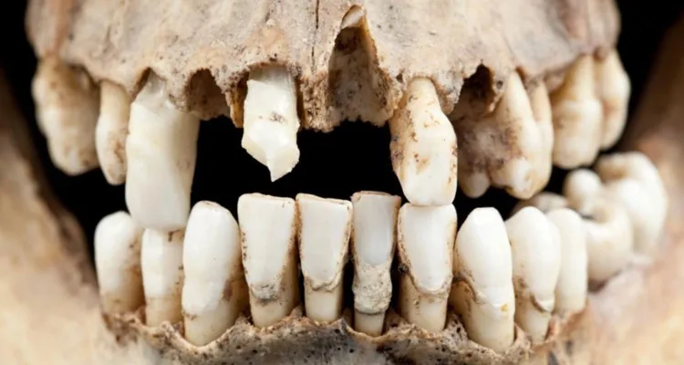 Imagem ilustrativa da notícia Bactérias dentária de neandertais são usados em antibióticos