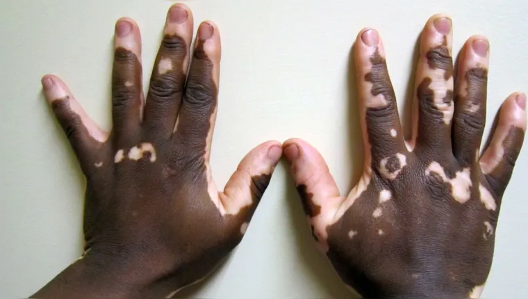 Imagem ilustrativa da notícia Vitiligo pode ser tratado no SUS; saiba como fazer!