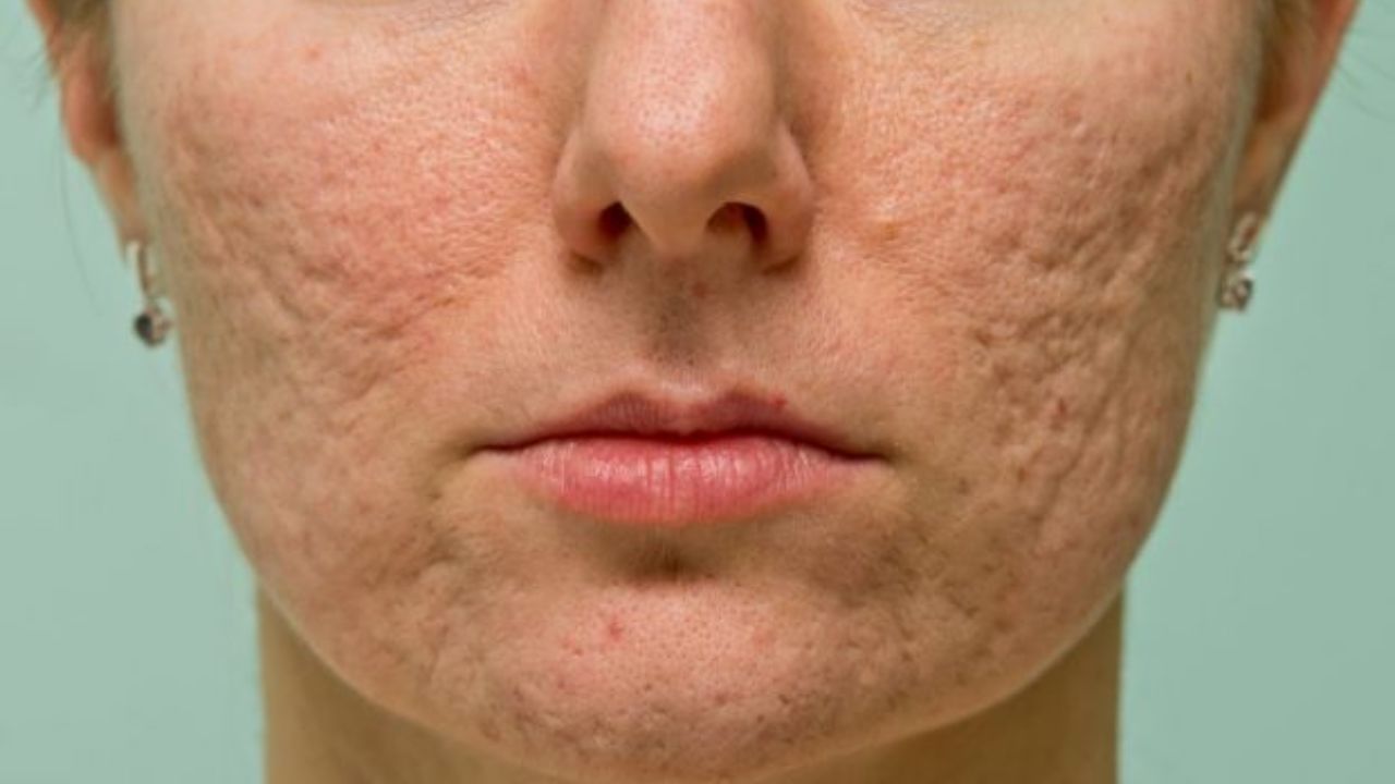 Tratamento para acne severa viraliza; conheça opções