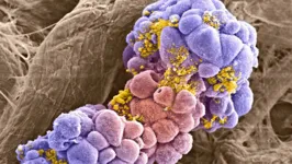 Células de câncer de mama, vistas com auxílio de microscópio eletrônico
Células de câncer de mama, vistas com auxílio de microscópio eletrônico