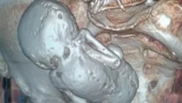 O feto apareceu durante exames de ultrassom e tomografia computadorizada