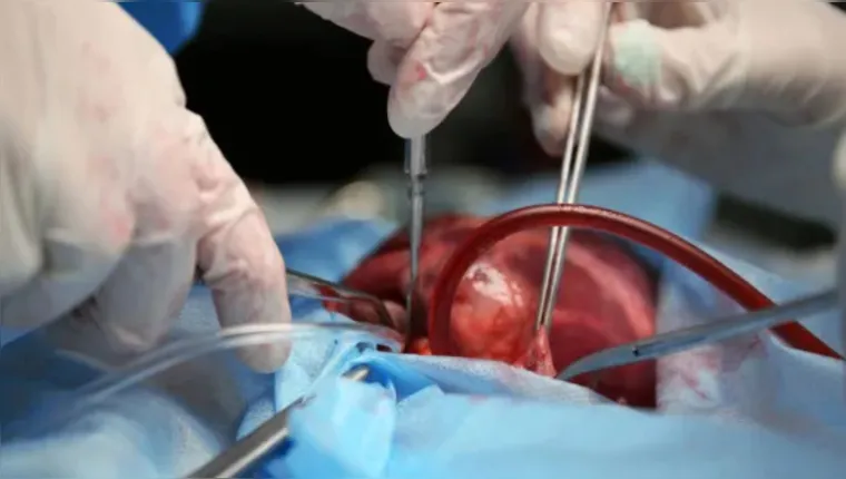 Imagem ilustrativa da notícia Brasil fez 206 transplantes de coração no primeiro semestre