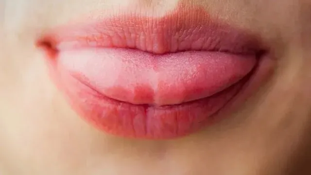 Imagem ilustrativa da notícia: A cor da língua pode revelar muito, até doença grave. Veja