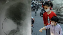 A doença está se espalhando em crianças das províncias de Pequim e Liaoning