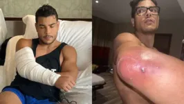 A infecção crônica no cotovelo acabou tirando Paulo Borrachinha do UFC 294, em Abu Dhabi.