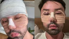 Rico Melquiades mostrou o resultado de suas cirurgias plásticas. Veja o antes e depois!