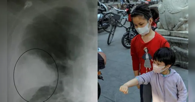 Imagem ilustrativa da notícia Epidemia: pneumonia desconhecida adoece crianças na China