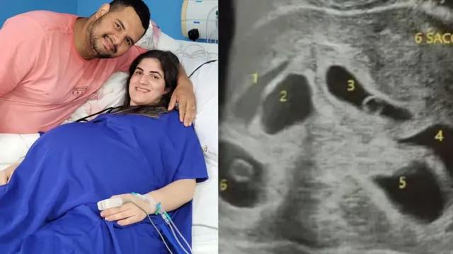 Imagem ilustrativa da notícia Mãe dá à luz a sêxtuplos em parto de apenas 10 minutos 