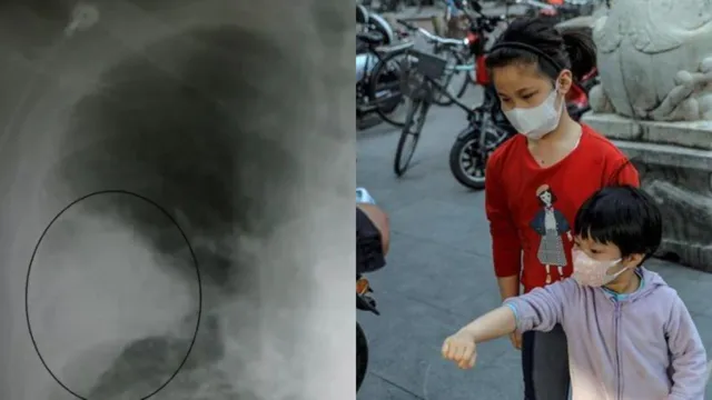 Imagem ilustrativa da notícia Epidemia: pneumonia desconhecida adoece crianças na China