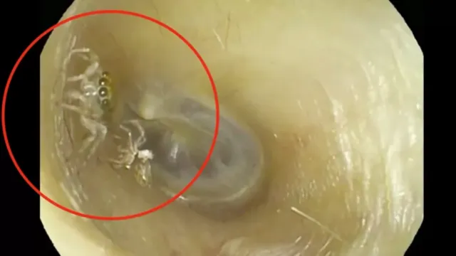 Imagem ilustrativa da notícia Médicos descobrem aranha "perturbadora" em ouvido de mulher