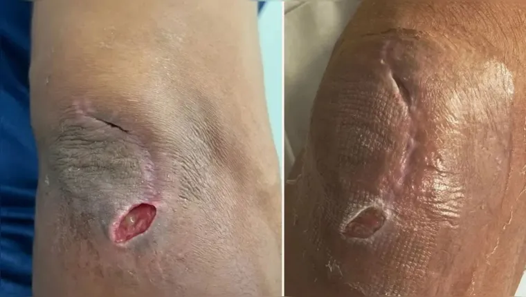 Imagem ilustrativa da notícia Veja a recuperação de Borrachinha após infecção no cotovelo