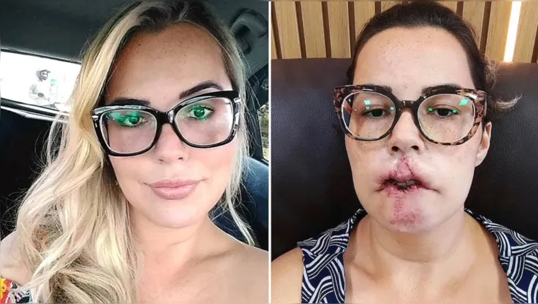 Imagem ilustrativa da notícia Mulher perde lábio superior após preenchimento labial