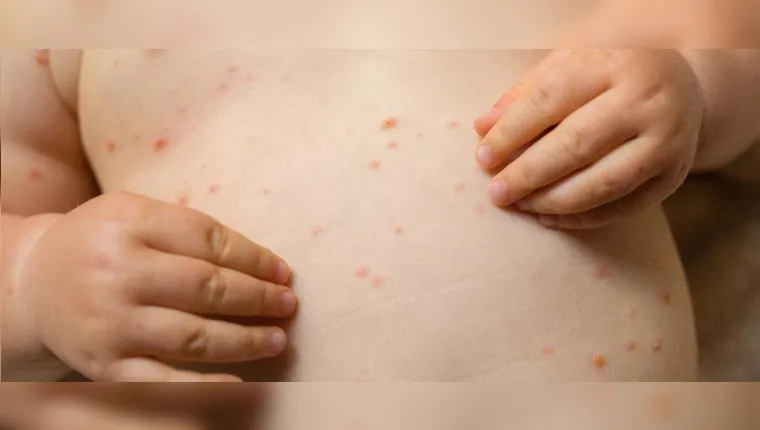 Imagem ilustrativa da notícia OMS alerta para os aumentos de casos de sarampo