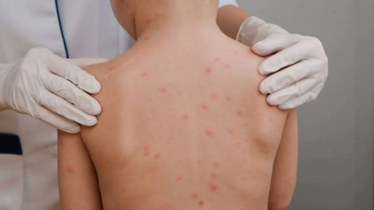Manchas na pele, dores de cabeça intensas e rigidez no pescoço são alguns dos sintomas da meningite