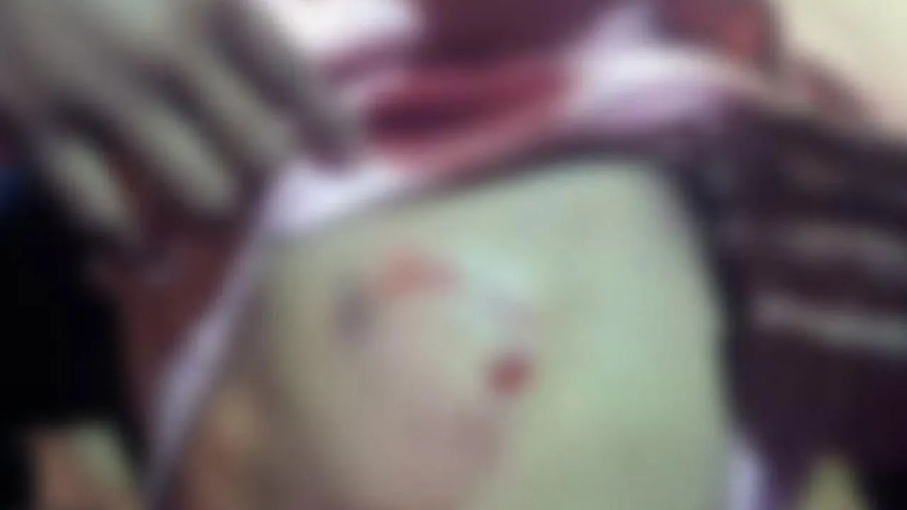 A menina foi atacada por um pitbull em Santa Teresa (RJ) e ficou ferida no peito, na cintura, nas costas e nas nádegas