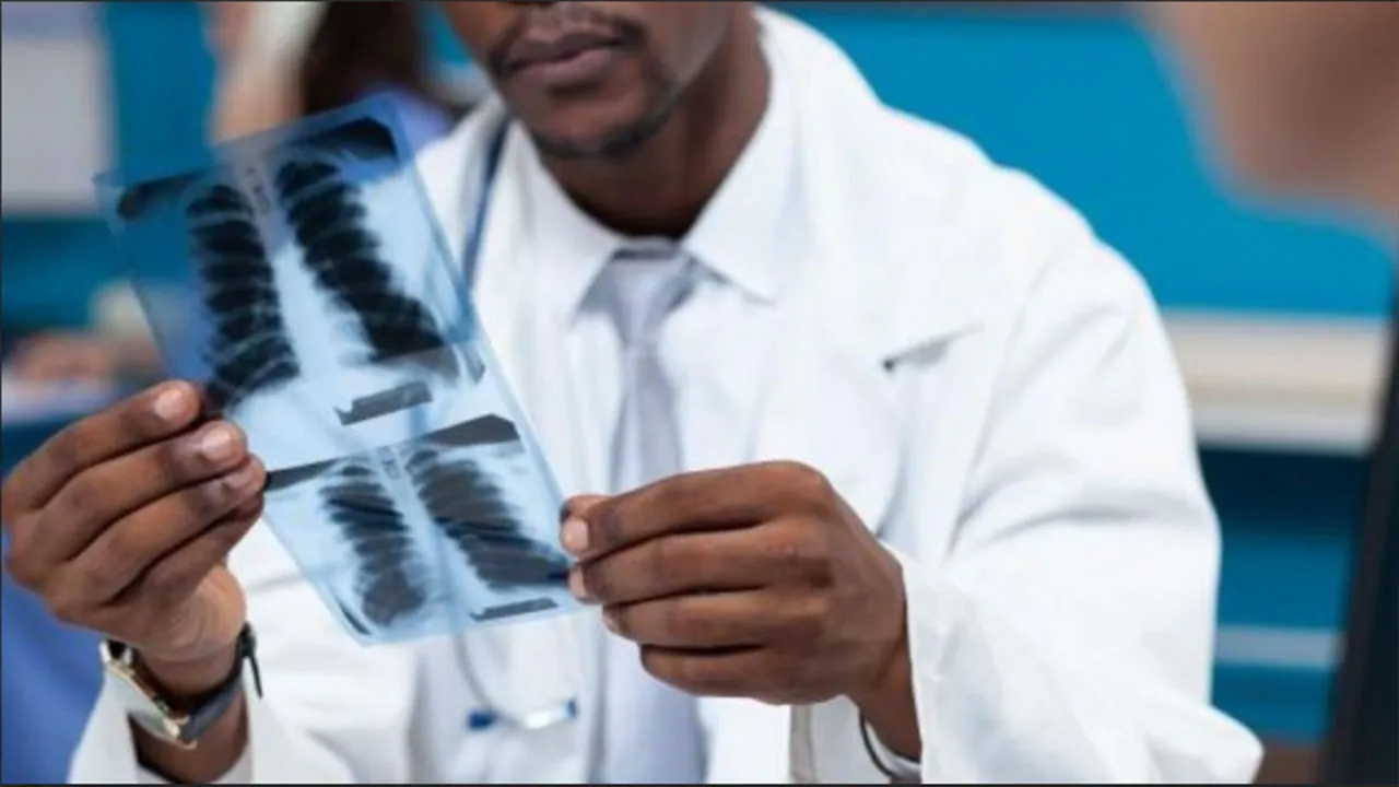 A tuberculose é uma doença infecciosa e transmissível que afeta, principalmente, os pulmões.