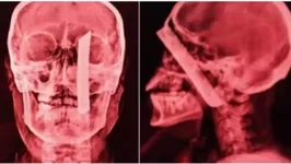 Foto de raio-x mostra a lâmina enfiada na cabeça da vítima