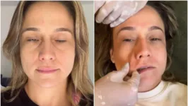 Fernanda Gentil mostra paralisia facial (esquerda) e realizando fisioterapia (direita).