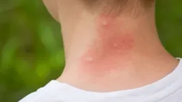 Picadas de mosquitos são um tormento para muita gente