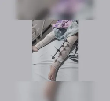 Imagem ilustrativa da imagem Erro médico: criança tem pinos colocados em perna errada