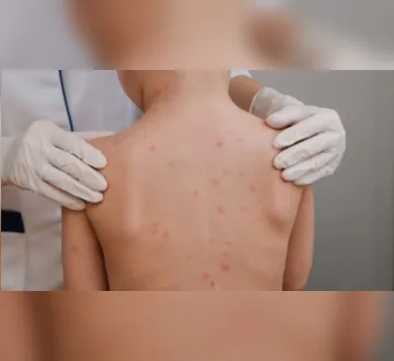 Imagem ilustrativa da imagem Jovem morre de meningite no Pará; outro caso é monitorado