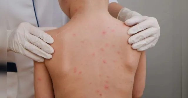 Imagem ilustrativa da notícia Jovem morre de meningite no Pará; outro caso é monitorado