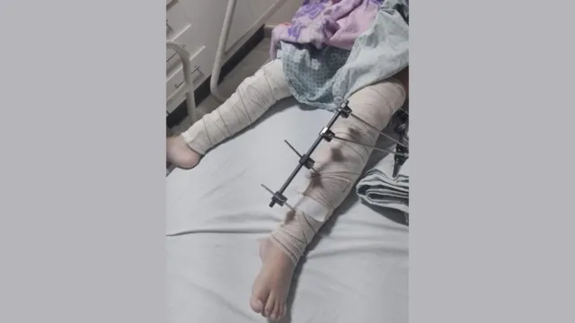 Imagem ilustrativa da notícia Erro médico: criança tem pinos colocados em perna errada