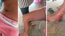 Cachorro invade escola e ataca estudante do 6º ano