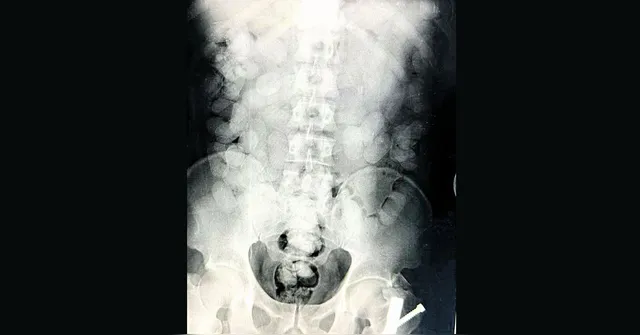 Imagem ilustrativa da notícia Passageiro é preso com cocaína no estômago
