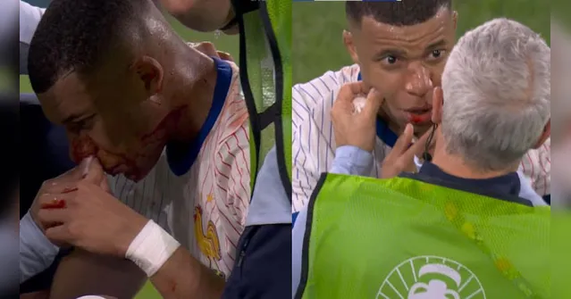 Imagem ilustrativa da notícia Mbappé quebra nariz e vira dúvida da França na Eurocopa