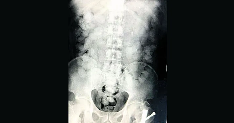 Imagem ilustrativa da notícia Passageiro é preso com cocaína no estômago