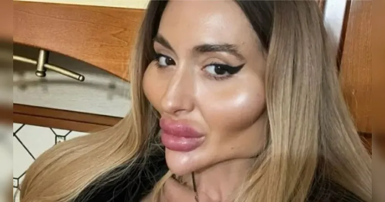 Imagem ilustrativa da notícia Mulher com maiores bochechas do mundo faz novo procedimento