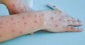 O Brasil registrou 945 casos de mpox nos 9 meses de 2024.