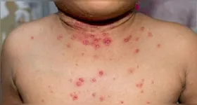 Infecção causa erupções que geralmente se desenvolvem pelo rosto e depois se espalham para outras partes do corpo.